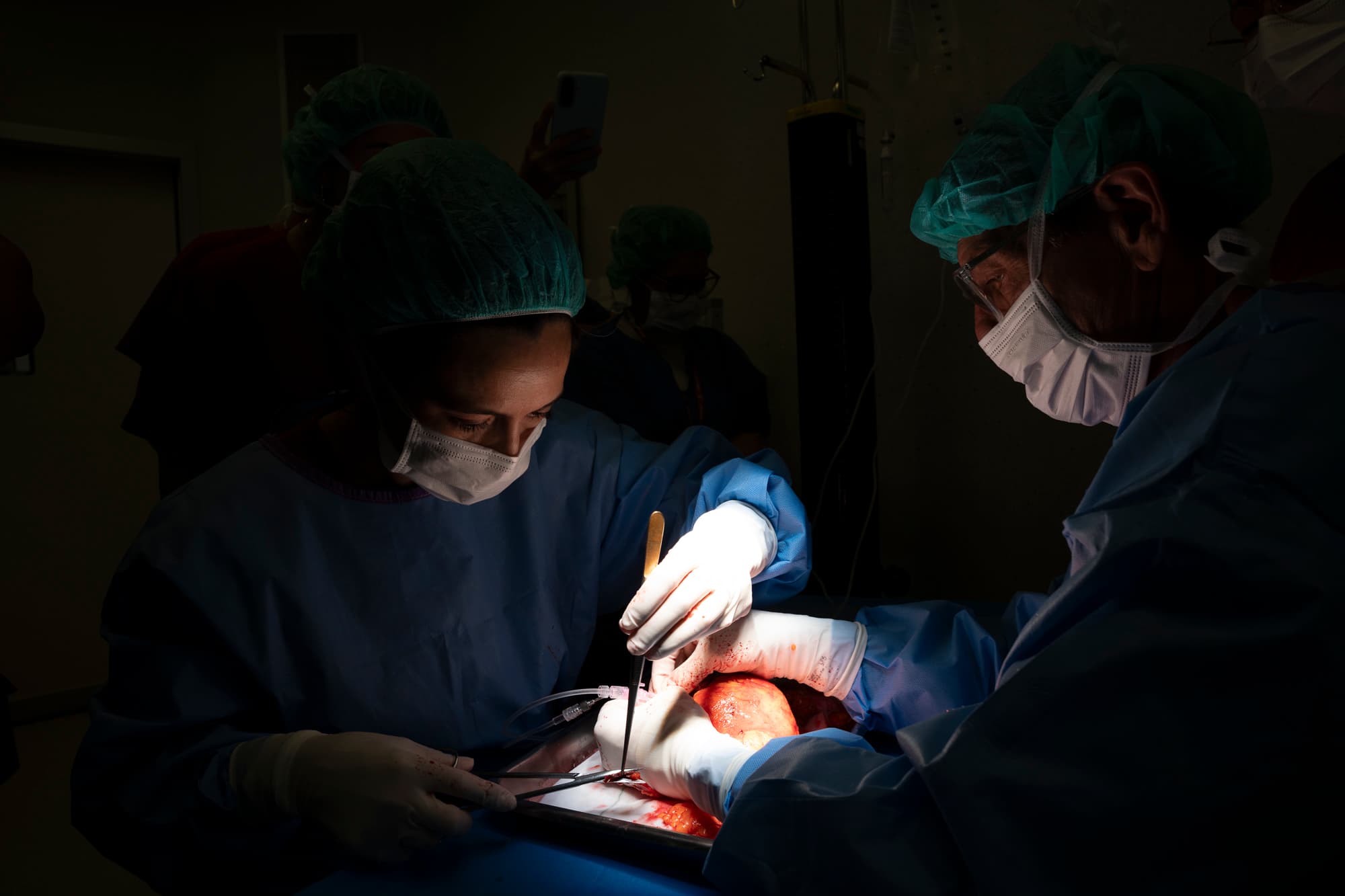 El Hospital de Bellvitge realiza el primer trasplante renal en Europa con cirugía robótica de una única incisión de solo siete centímetros